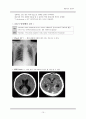 신경외과 중환자실 뇌종양 case 간호진단, 인공호흡기, 동맥혈 가스분석 자료 15페이지