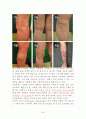 운동과 건강(하지정맥류) 8페이지