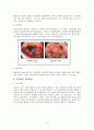 후두암(larynx cancer)수술 8페이지