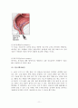 치질(Hemorroid) 11페이지