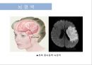 뇌혈관질환(뇌졸중) (Cerebrovascular disease).ppt 6페이지