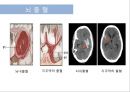 뇌혈관질환(뇌졸중) (Cerebrovascular disease).ppt 7페이지