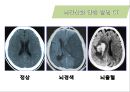 뇌혈관질환(뇌졸중) (Cerebrovascular disease).ppt 24페이지