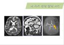 뇌혈관질환(뇌졸중) (Cerebrovascular disease).ppt 25페이지