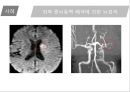 뇌혈관질환(뇌졸중) (Cerebrovascular disease).ppt 40페이지