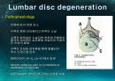미세현미경 디스크제거술(Micro lumbar discectomy)PPT 5페이지