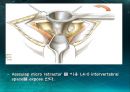 미세현미경 디스크제거술(Micro lumbar discectomy)PPT 29페이지