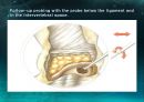 미세현미경 디스크제거술(Micro lumbar discectomy)PPT 35페이지