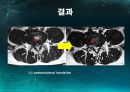 미세현미경 디스크제거술(Micro lumbar discectomy)PPT 39페이지