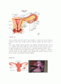 [모성간호학][자궁근종][myoma uteri][Uterine myoma]케이스 스터디(Case Study), 문헌고찰 2페이지