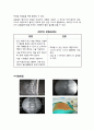 [의학] 고주파열 디스크 시술 (Intra Discal Electrothermical Theraphy) 2페이지