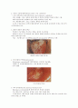 구강캔디다증 2페이지