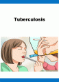 Tuberculosis 케이스 ( Tuberculosis 케이스, Tuberculosis 간호과정, Tuberculosis CASE, 결핵 케이스, 결핵 간호과정, 결핵 사례연구, 폐결핵 간호과정, 폐결핵 케이스 스터디) 1페이지